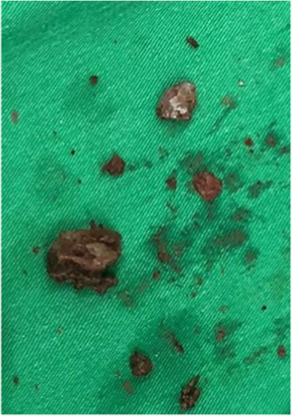 Pedra encontrada na vagina de mulher foi quebrada com laser Foto ReproduoUrology Case Reports