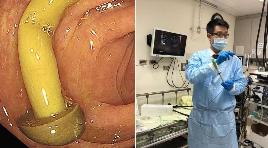 Mdico Lin Xianghong descobriu cogumelo crescendo no intestino de paciente em Taiwan